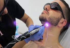 لیزر موهای زائد مردان در کرج با بهترین دستگاه